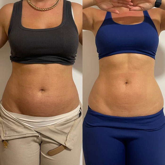 Body contouring