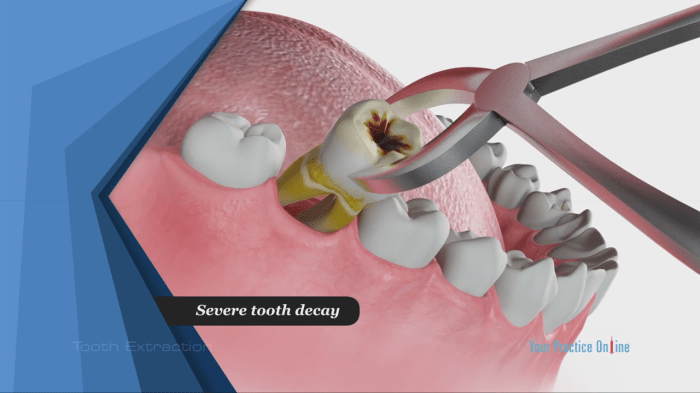 Tooth extraction
