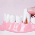 Tooth extraction